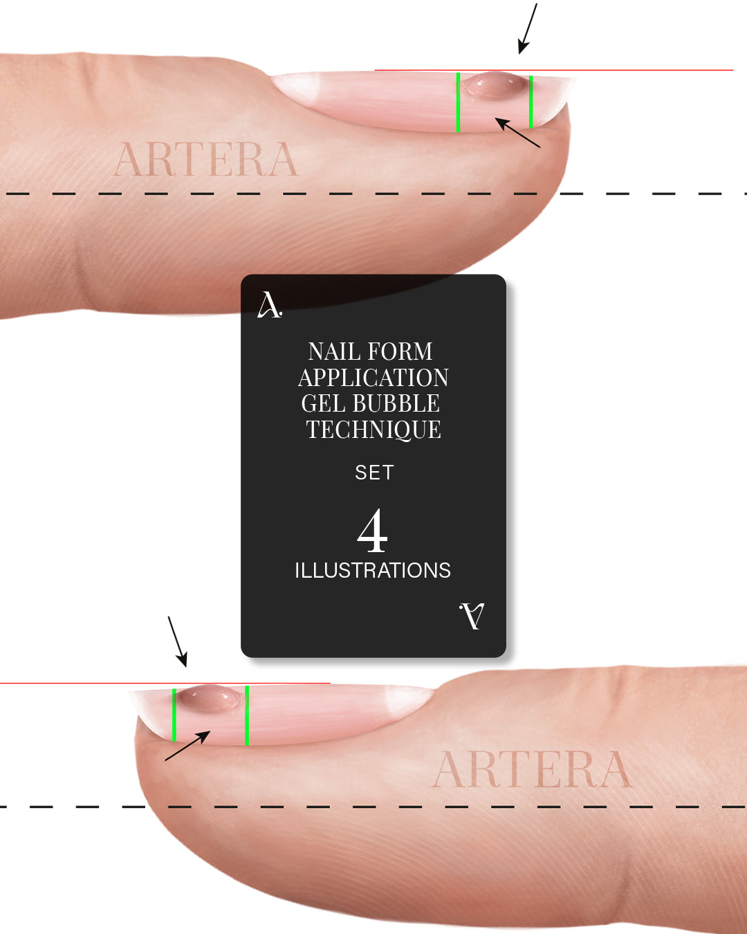 Gel Bubble Tip Application Technique - Set of 4 Illustrations
